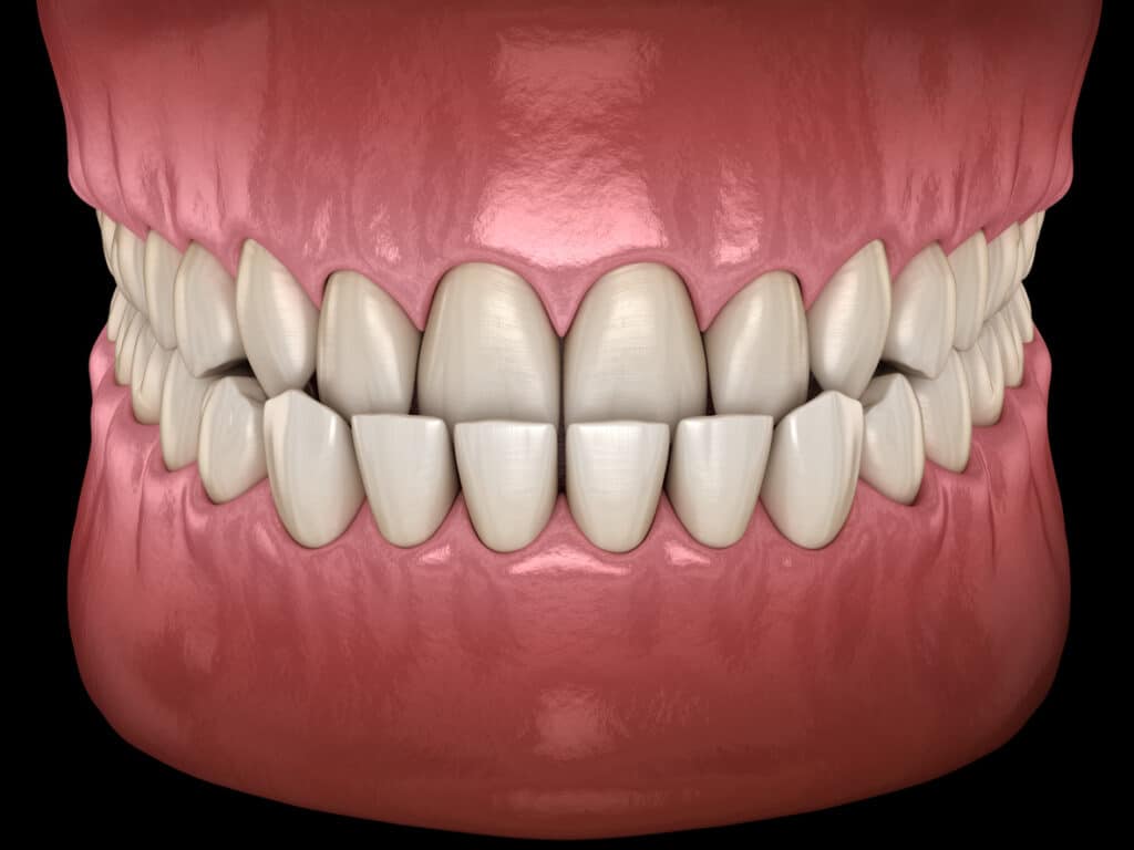 Common Orthodontic Problems | A Smile by Design