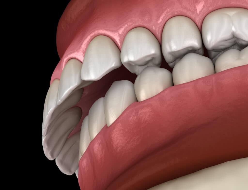 Upper front teeth protrusion orthodontic bite example at Smile By Design Orthodontics in Durango, Cortez, and Pagosa Springs, CO